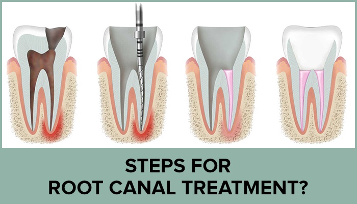 What You Need To Know: Understanding Root Canal Treatment
