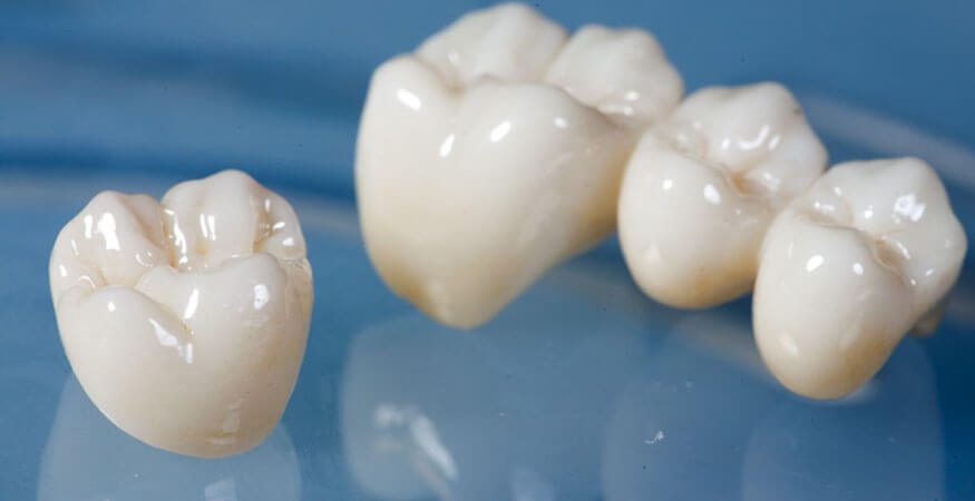 5 Situations Where You Will Need Tooth Crowns